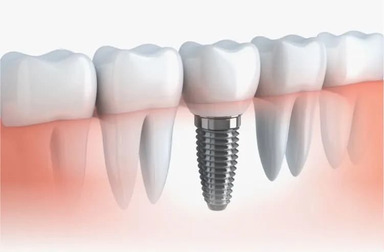 健康な歯を守るためのインプラント
